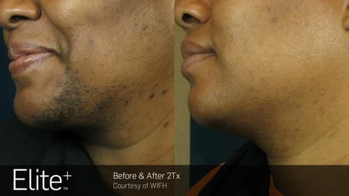 Customer photo review of Velura® Rotundus Therapy