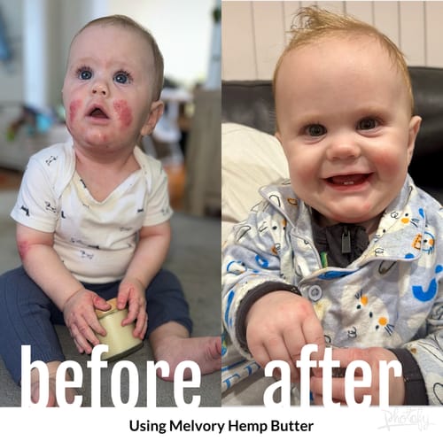 Customer photo review of Skin Rescue Set Hemp & Calendula