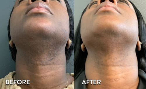 Customer photo review of Velura® Rotundus Therapy