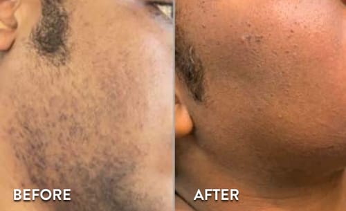 Customer photo review of Velura® Rotundus Therapy