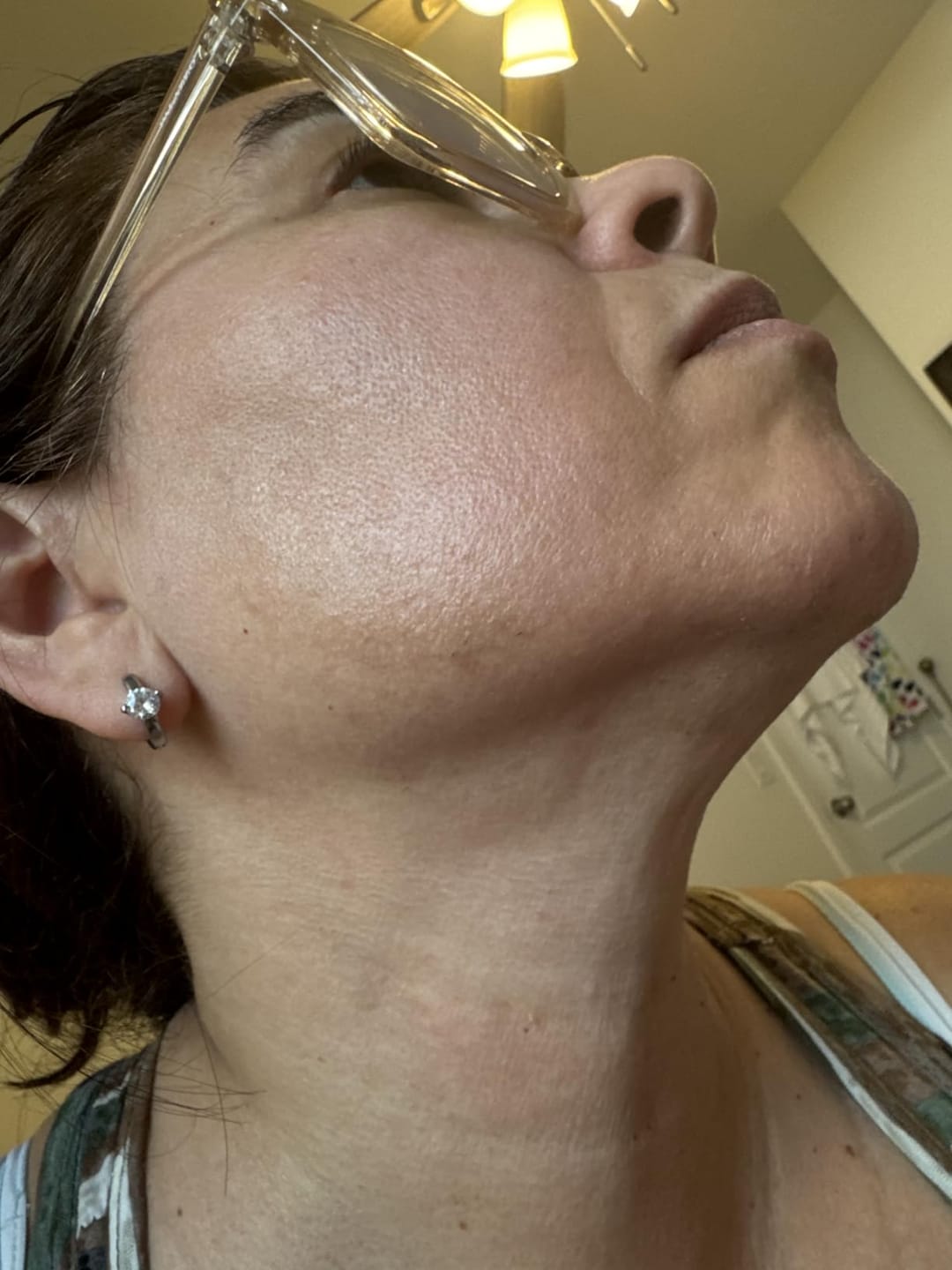 Customer photo review of Velura® Rotundus Therapy