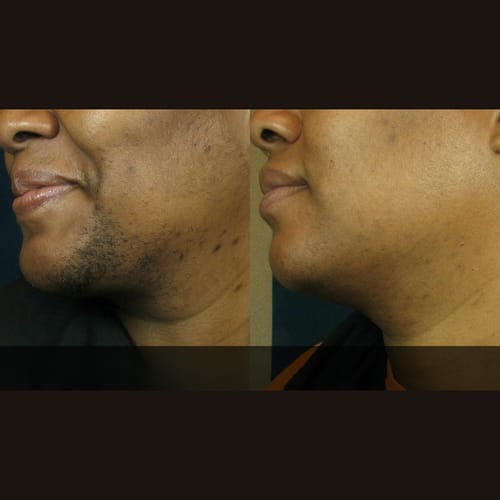 Customer photo review of Velura® Rotundus Therapy