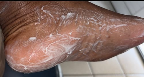 Customer photo review of Gommage solide des pieds