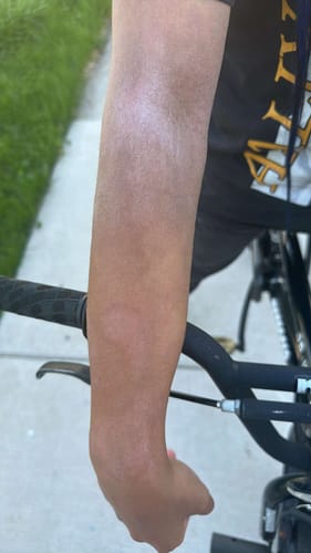 Customer photo review of Tallow Soothe Stick Skin Balm Stick for Eczema and Dry, Cracked Skin, Soothing effect for itch and irritation