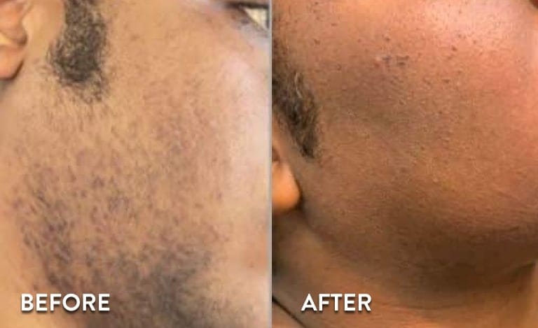 Customer photo review of Velura® Rotundus Therapy