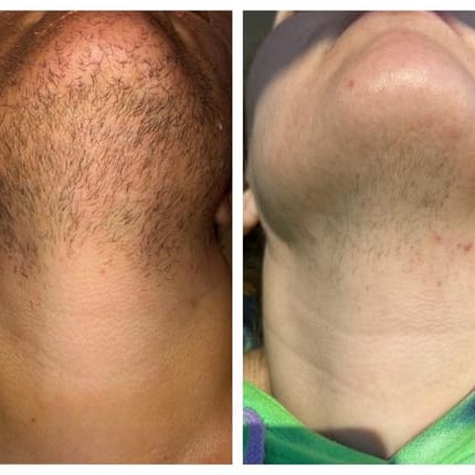 Customer photo review of Velura® Rotundus Therapy