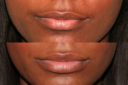 Customer photo review of Velura® Rotundus Therapy