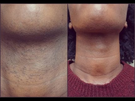 Customer photo review of Velura® Rotundus Therapy