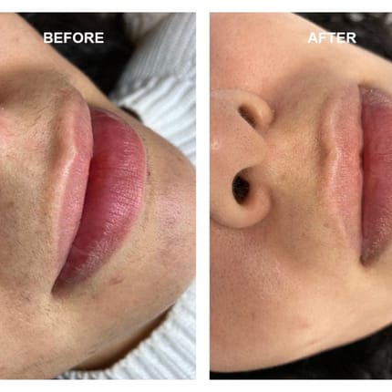 Customer photo review of Velura® Rotundus Therapy