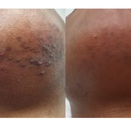 Customer photo review of Velura® Rotundus Therapy