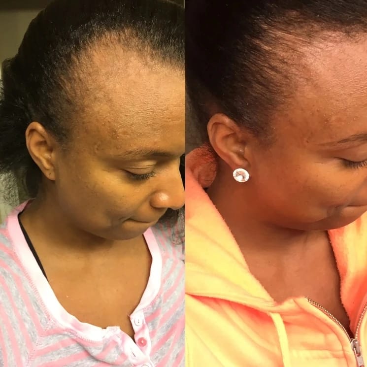 Customer photo review of Chebe Fast Hair Growth Sevich Traction Alopecia Hair Karkar Oil Anti Hair Break Hair Strengthen Hair Loss Care Repair Damage