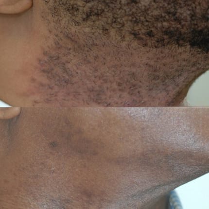 Customer photo review of Velura® Rotundus Therapy