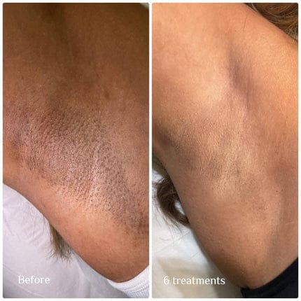 Customer photo review of Velura® Rotundus Therapy