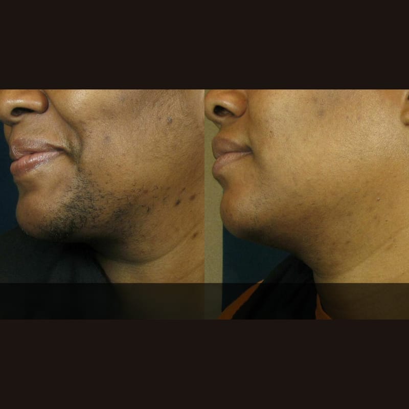 Customer photo review of Velura® Rotundus Therapy