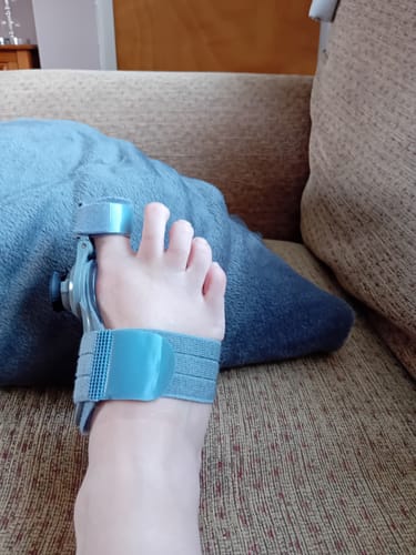 Customer photo review of Treatmedy™ Bunion Fix - Natural At-Home Bunion Relief