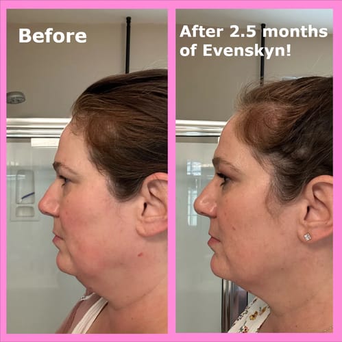 Customer photo review of EvenSkyn® Lumo⁺: Premium Anti-Aging & Skin Tightening Handset