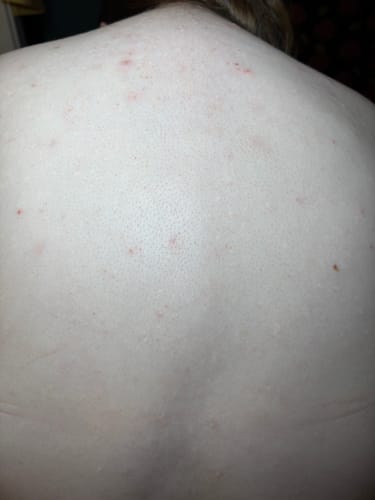 Customer photo review of Blemish Balance