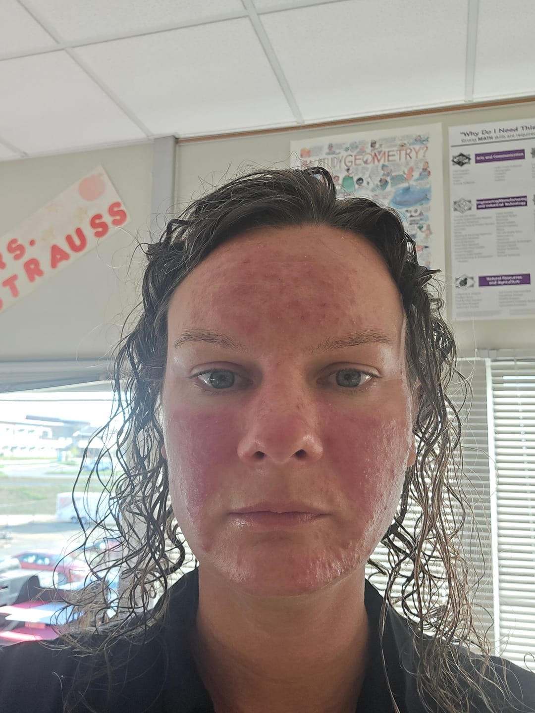 Customer photo review of Kill Acne & Redness Ritual