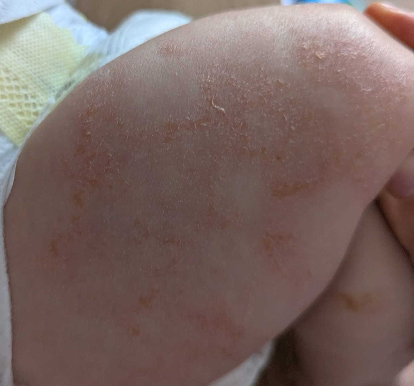 Customer photo review of Bioskin Junior Duo Pack