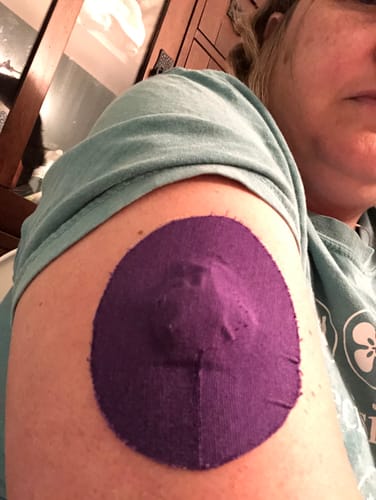 Customer photo review of Skin Grip Original - Medtronic Guardian/Enlite Adhesive Patches