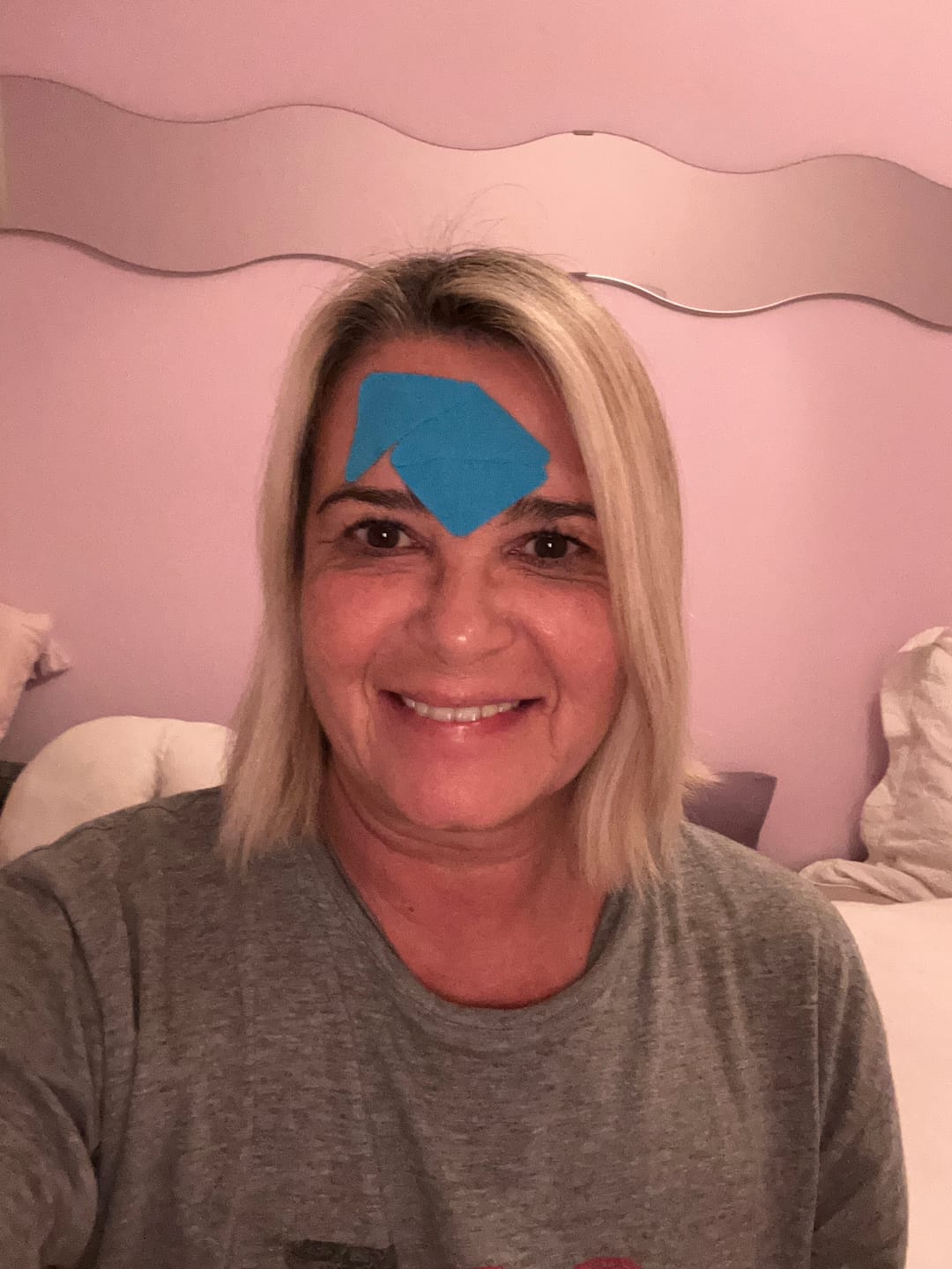 Customer photo review of Zornesfalten Patches mit Hyaluron - blau