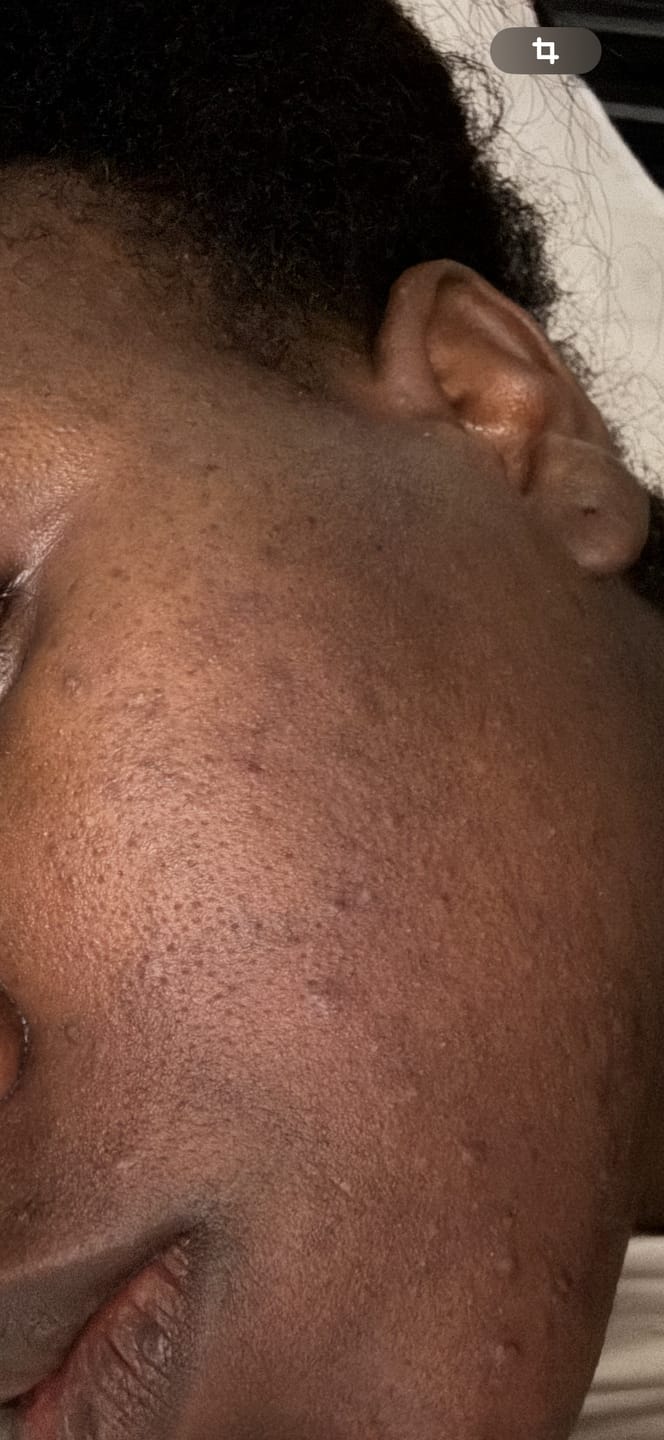 Customer photo review of Routine Anti-Imperfections 4 en 1