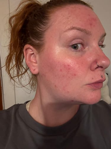 Customer photo review of BeautyPro 2.0 - High Frequency Wand