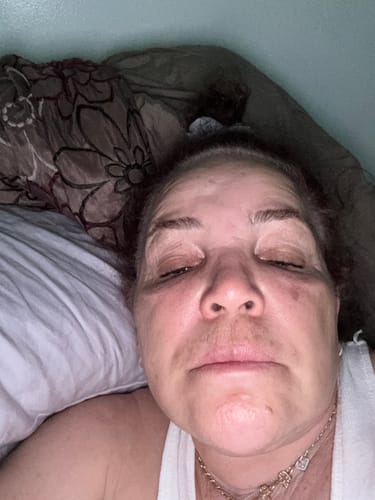 Customer photo review of SkinFix: Signature Laser Facial