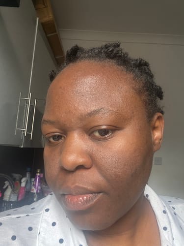 Customer photo review of Anti-Acne & Dark Spots African Soap
