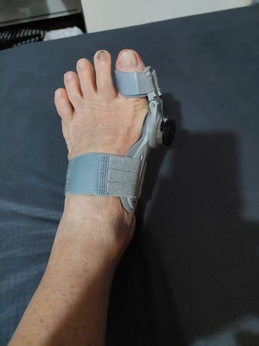 Customer photo review of Treatmedy™ Bunion Fix - Natural At-Home Bunion Relief