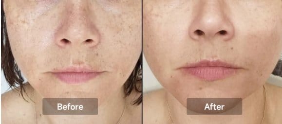 Customer photo review of LUMYHEALTH™ LED Red Light Therapy Face Mask(8 Colors)