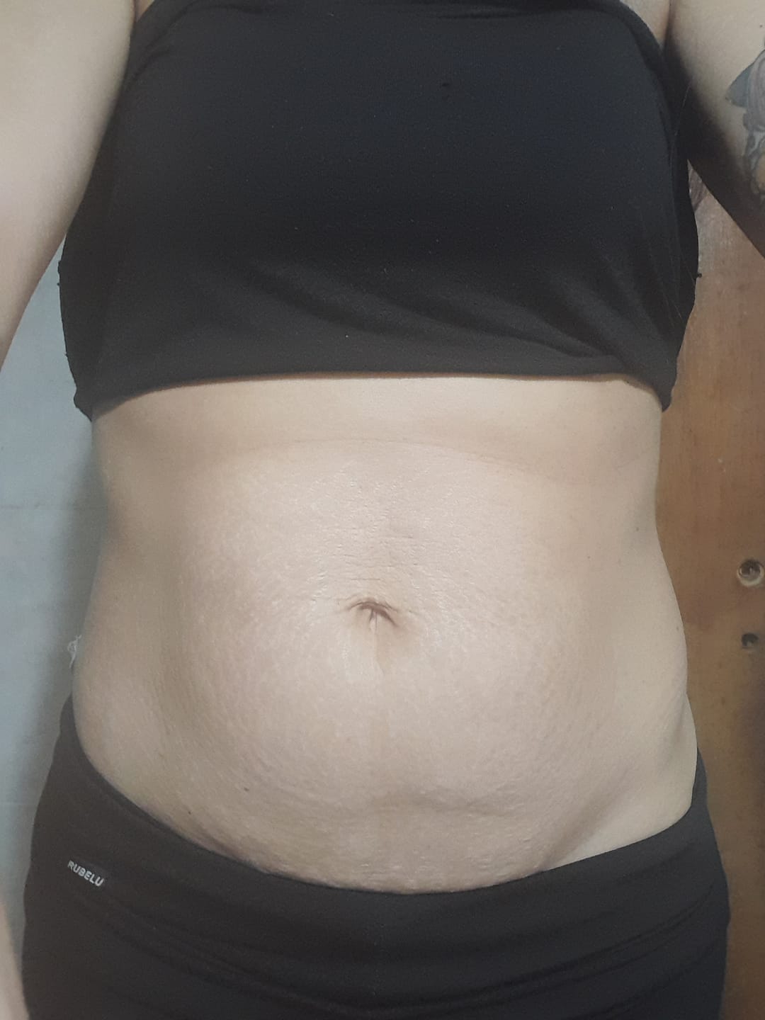 Customer photo review of Crema AntiEstrías🧴🦵 - 200ml EMILY