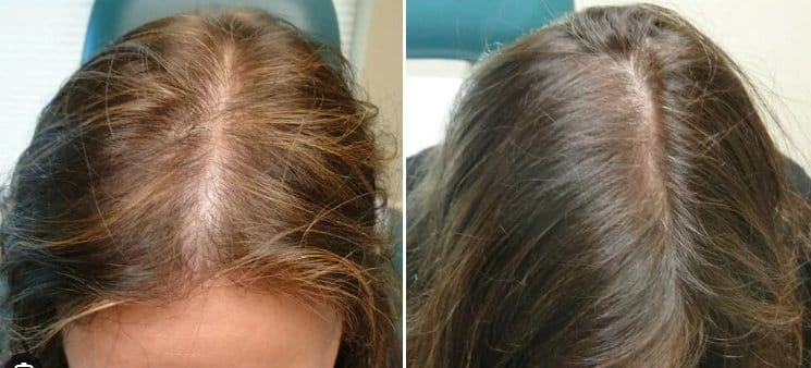 Customer photo review of LED Therapy Cap