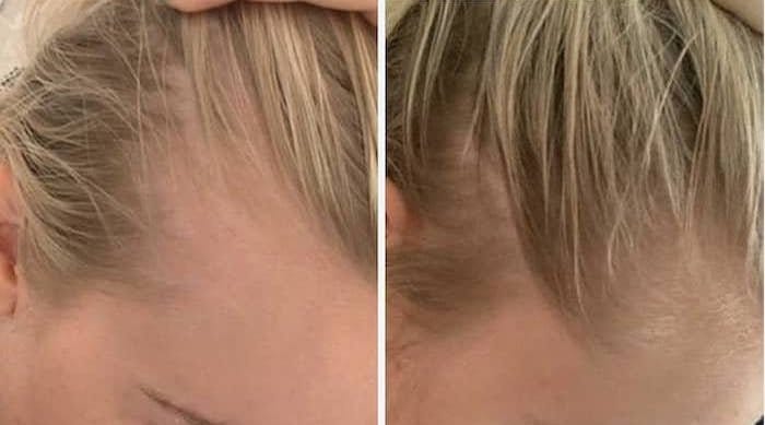 Customer photo review of LED Therapy Cap
