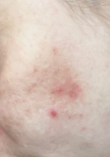 Customer photo review of SOME BY MI - 30 Days Miracle AC SOS Kit - 4 piezas