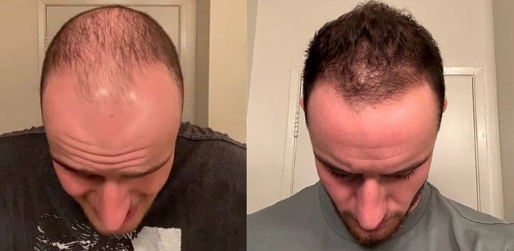 Customer photo review of LED Therapy Cap