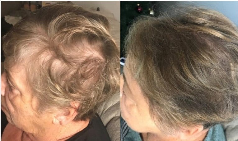 Customer photo review of LED Therapy Cap
