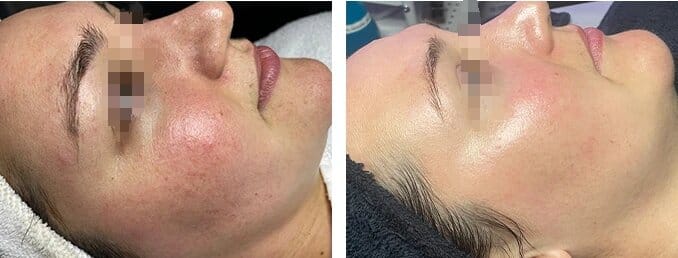 Customer photo review of Lumyhealth Salon LED Light Therapy Device