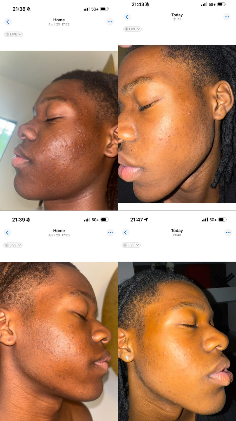 Customer photo review of LIMITED EDITION: Jolie’s Mini Full Body & Face Brightening Kit/ Acne Kit