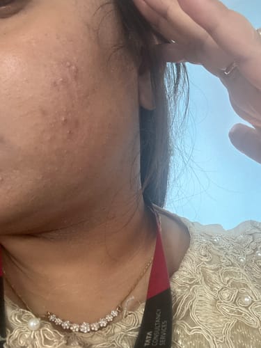 Customer photo review of Suroskie My Glow All-In-One Tinted Moisturizer with SPF 30 - Hydration, Sun Protection With SPF 30, Radiant Finish, Even Skin Tone, For All Skin Types (60ml)