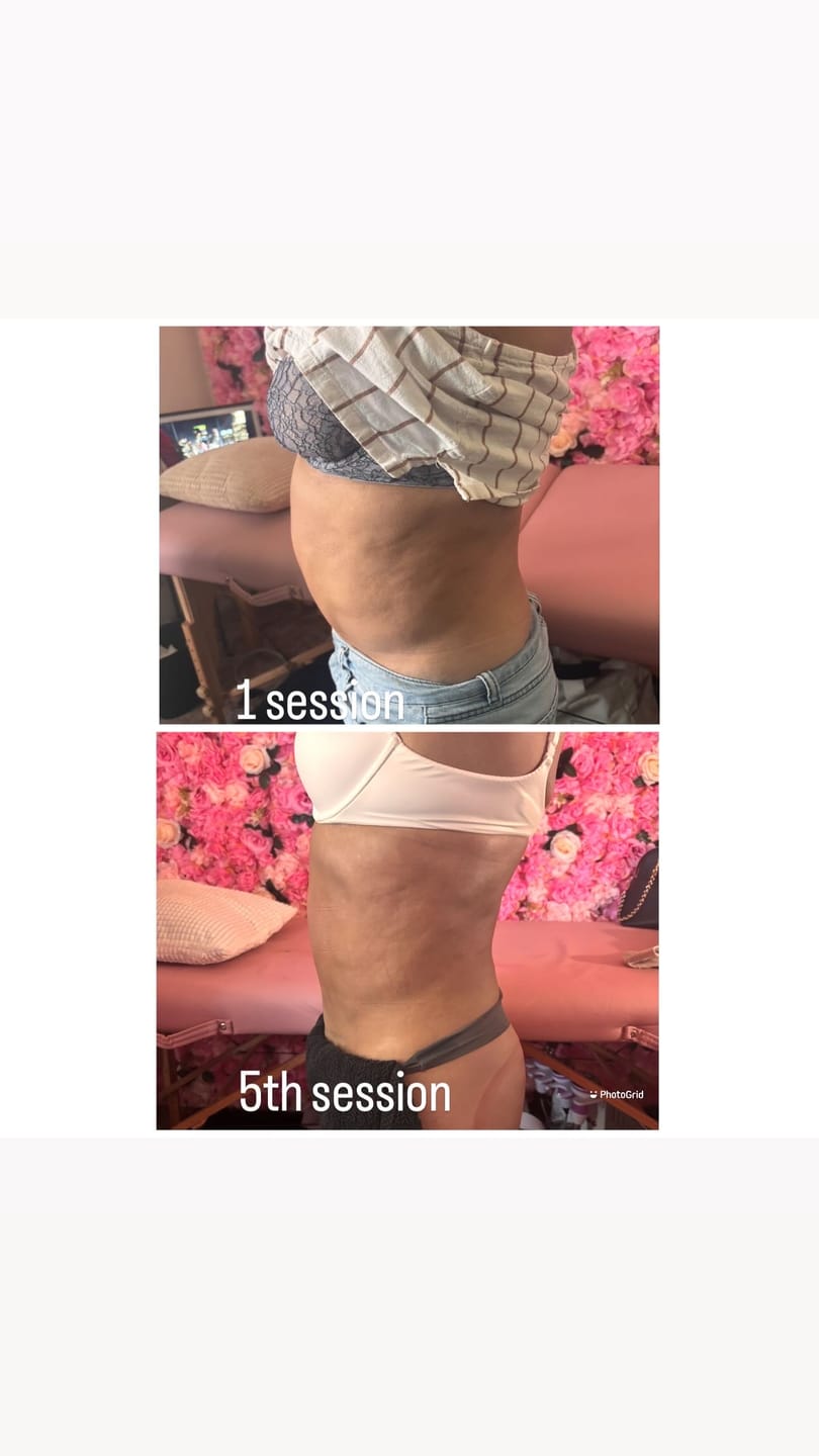 Customer photo review of Eris Lipo Cavitation Machine 6 in 1 Professional