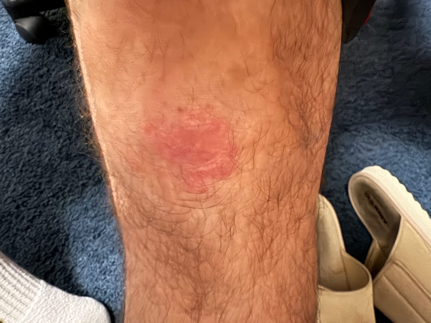 Customer photo review of Psoriasis Honey Skin-Renewing Cream