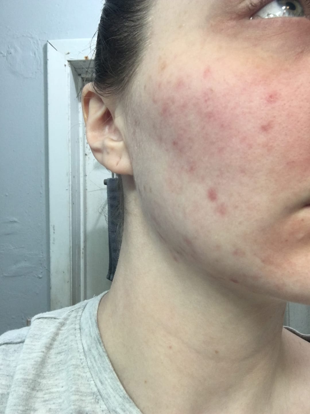 Customer photo review of The Complete Acne System for Women
