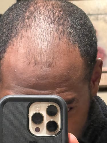 Customer photo review of Rennora Hair Growth Serum