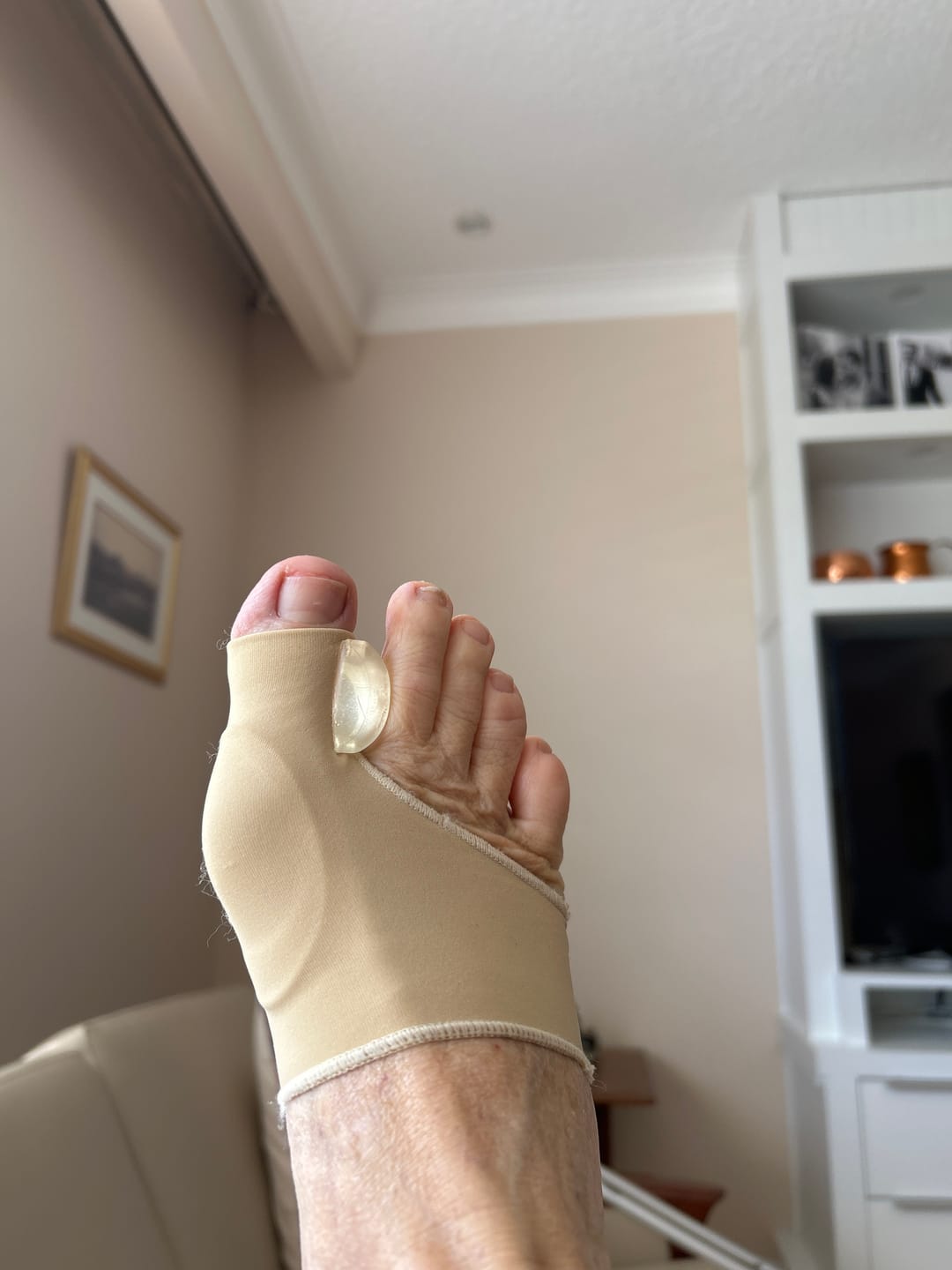 Customer photo review of Treatmedy™ Orthopedic Daytime Bunion Sleeve