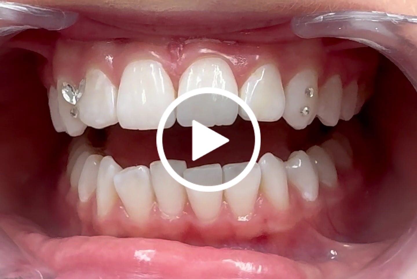 Customer video review of Crystal Clear Butterfly 4-pack