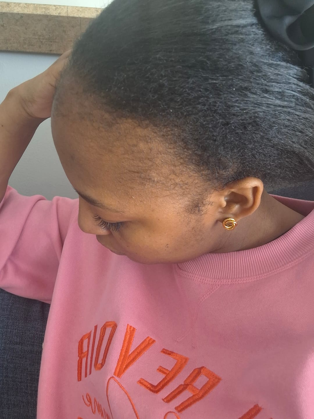 Customer photo review of New Formula: Hairline Fortifying Serum 30ml