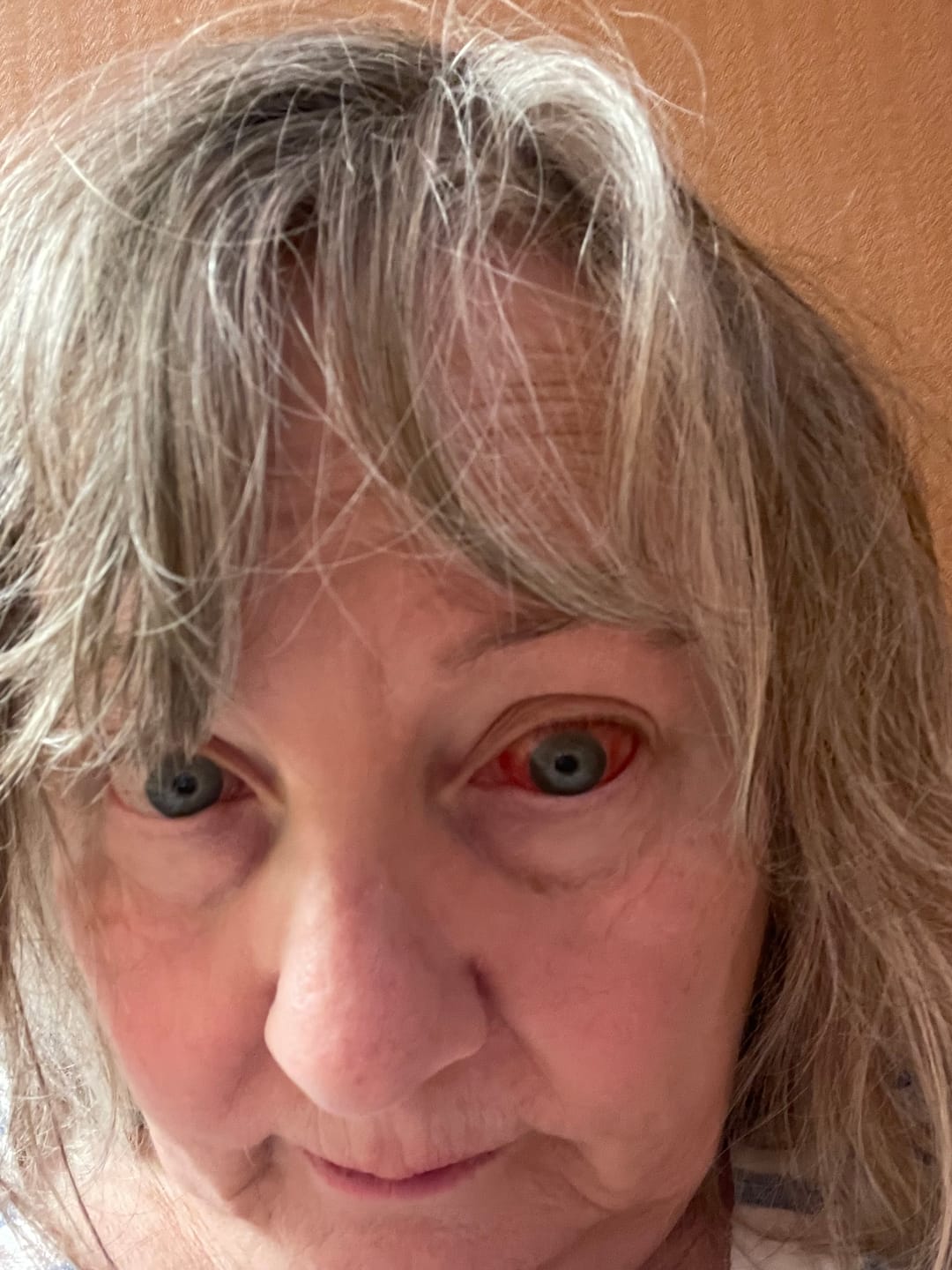 Customer photo review of OPTASE® Single Dose Dry Eye Intense Drops