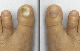 Customer photo review of NUVEX FungalFix™