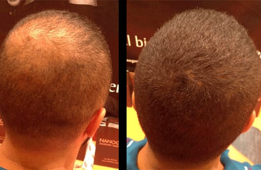 Customer photo review of SKALPURE® – Corrector Capilar Profesional